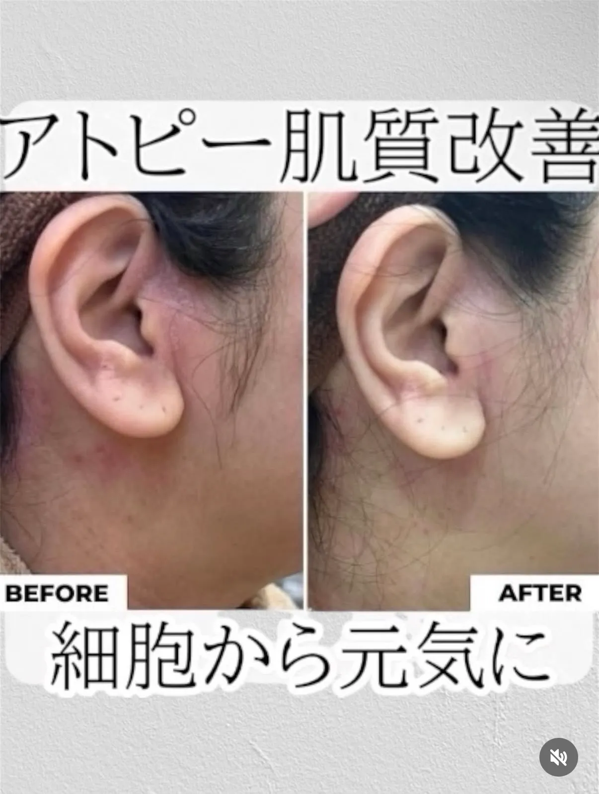 ハーブピーリング